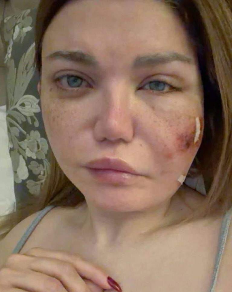 أصابة ياسمين الخطيب بعدوى خطيرة أثناء عملية تجميل بالوجة